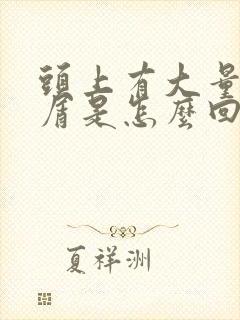 头上有大量头皮屑是怎么回事封面