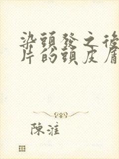 染头发之后有大片的头皮屑怎么办