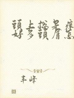 头上总是痒还有好多头屑怎么办啊