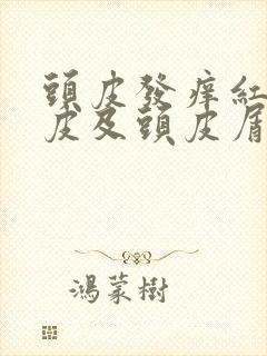 头皮发痒红斑头皮及头皮屑封面