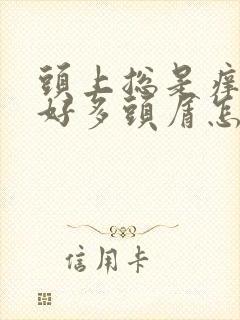 头上总是痒还有好多头屑怎么办啊