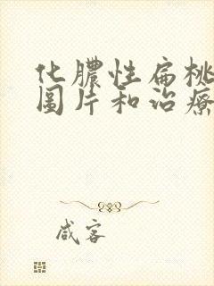 化脓性扁桃体炎图片和治疗