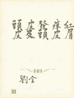 头皮发痒红斑头皮及头皮屑