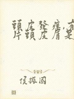 头皮发痒,有大片头皮屑是怎么回事