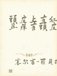 头皮上有红斑而且痒有头皮屑封面