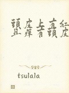 头皮上有红斑而且痒有头皮屑