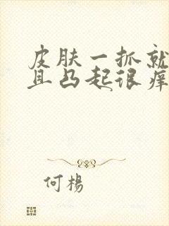 皮肤一抓就红而且凸起很痒