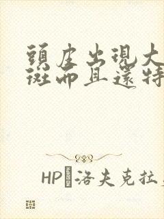 头皮出现大量红斑而且还特别痒