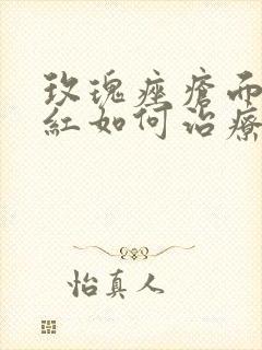 玫瑰痤疮面部潮红如何治疗好封面