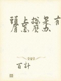 头上总是有头皮屑怎么办