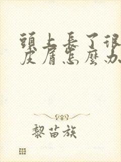 头上长了很多头皮屑怎么办