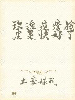 玫瑰痤疮脸上脱皮是快好了吗