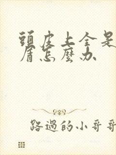 头皮上全是头皮屑怎么办