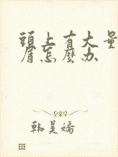 头上有大量头皮屑怎么办