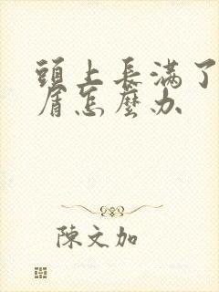 头上长满了头皮屑怎么办