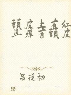 头皮上有红斑而且痒有头皮屑封面