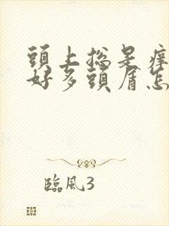 头上总是痒还有好多头屑怎么办啊