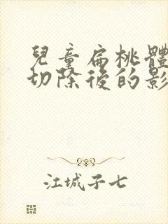 儿童扁桃体肥大切除后的影响