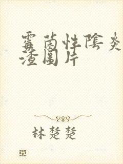 霉菌性阴炎豆腐渣图片