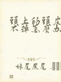 头上的头皮屑洗不掉怎么办?