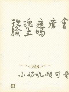 玫瑰痤疮会长在脸上吗