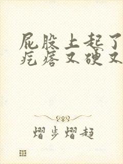 屁股上起了个大疙瘩又硬又痒封面