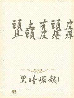 头上有头皮屑而且头皮瘙痒怎么办封面