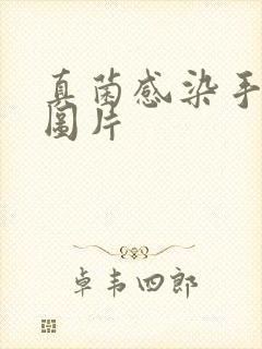 真菌感染手指甲图片