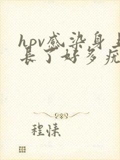 hpv感染身上长了好多疣体怎么治疗