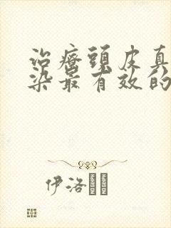 治疗头皮真菌感染最有效的药