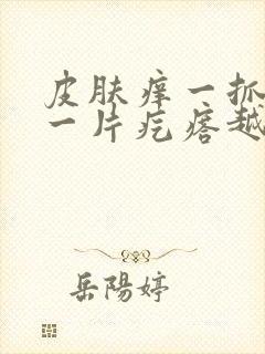 皮肤痒一抓就起一片疙瘩越挠越痒用什么药