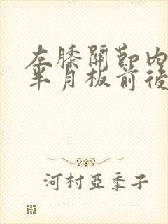 左膝关节内外侧半月板前后角两度损伤