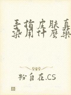 手指皮肤真菌感染用什么药最好