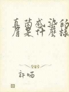 真菌感染的头皮屑是什么样的