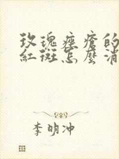 玫瑰痤疮的固定红斑怎么消除