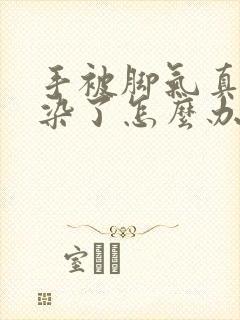 手被脚气真菌感染了怎么办