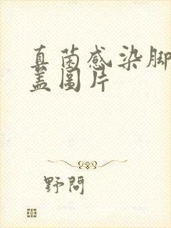 真菌感染脚指甲盖图片