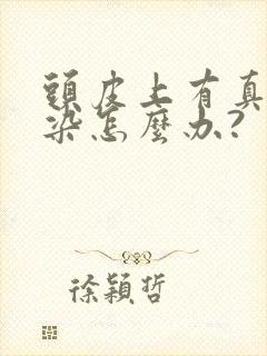 头皮上有真菌感染怎么办?