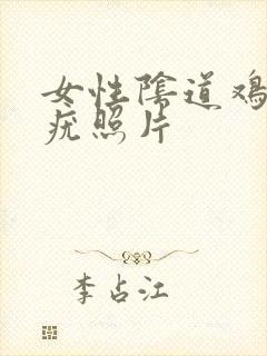 女性阴道鸡冠状疣照片