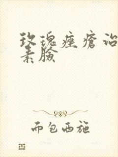 玫瑰痤疮治疗激素脸