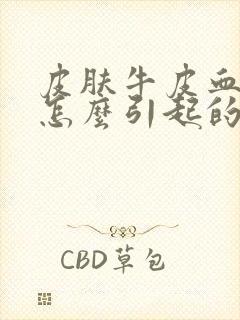 皮肤牛皮血癣是怎么引起的