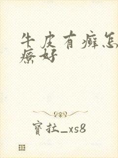 牛皮有癣怎样治疗好