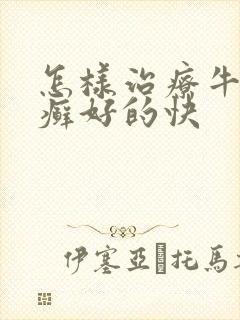怎样治疗牛皮有癣好的快