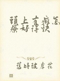 头上有癣怎么治疗好得快