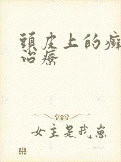 头皮上的癣怎么治疗