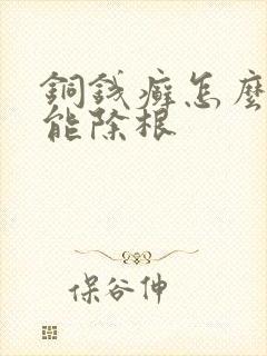 铜钱癣怎么治才能除根