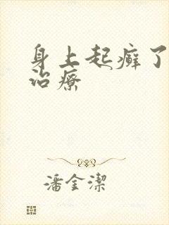 身上起癣了怎么治疗