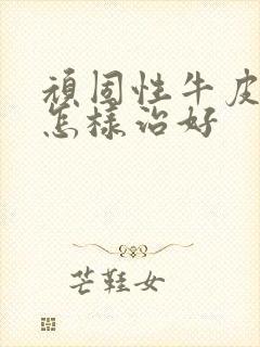 顽固性牛皮有癣怎样治好