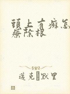 头上有癣怎么治疗除根