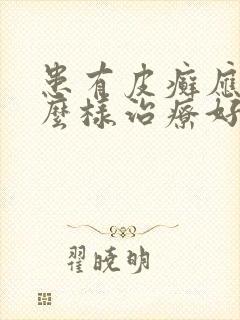 患有皮癣应该怎么样治疗好